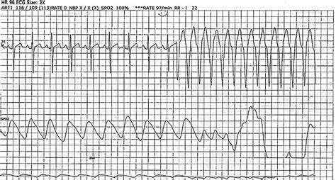 Figure 1 From Effect Of Stellate Ganglion Block In Patients With