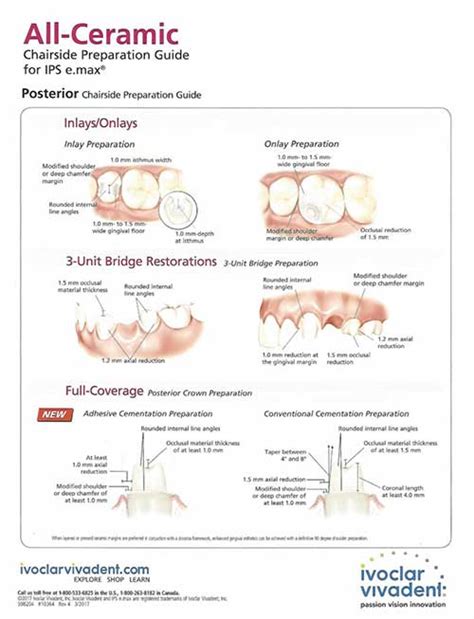 All Ceramic Crown Preparation