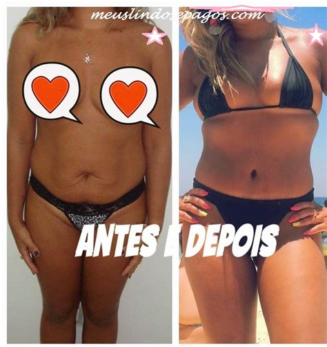 Meus Lindos E Pagos Arquivos Abdominoplastia Sem Lipoaspira O