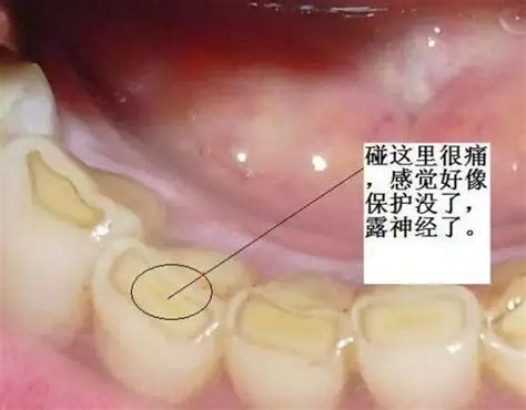 为什么牙齿怕冷、怕热、怕酸，你知道吗？ 知乎