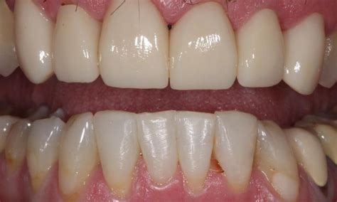 Scottsdale Dental Centre Before And After Photos Guelph Dentist