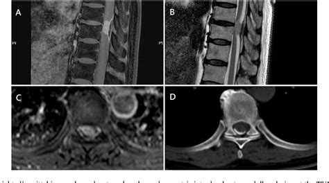 Figure 1 From Ossified Thoracic Spinal Meningioma With Lamellar Bone