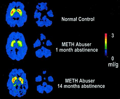 Effects Of Meth On The Brain