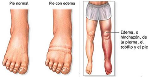 Linfedema: causas, síntomas y tratamiento - eSalud.com