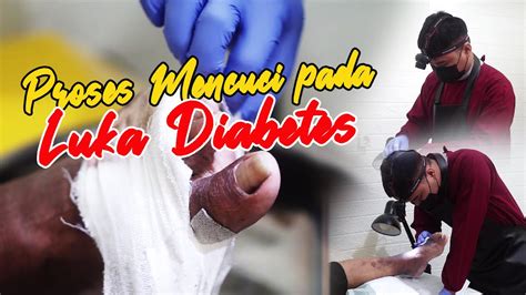 Mencuci Luka Diabetes Youtube