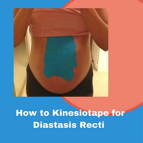 Albums 96 Pictures Diastasis Recti Pictures Before And After Updated