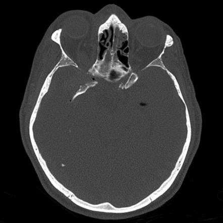 Pneumocephalus Radiology Reference Article Radiopaedia Org