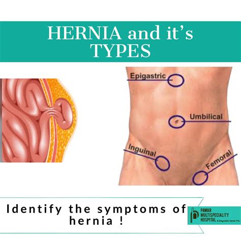 Top Pictures Pictures Of A Hernia In The Stomach Completed