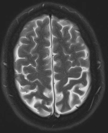 Subarachnoid hemorrhage MRI - Questions and Answers in MRI