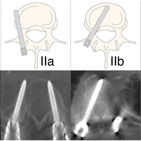 Visual Representation Of Pedicle Screw Placement Grading System Download Scientific Diagram