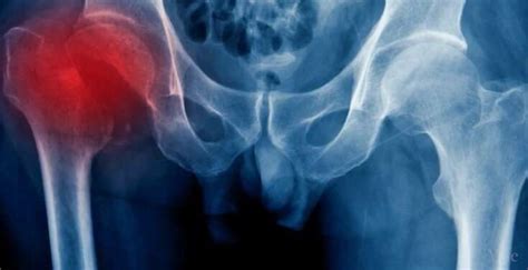 Avoiding Hip Replacement How Stem Cells Can Treat Avascular Necrosis