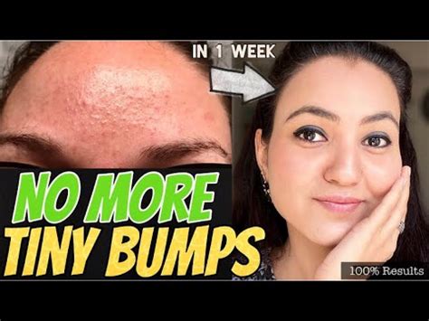 Week Challenge Get Rid Of Tiny Bumps Naturally In Just Days And