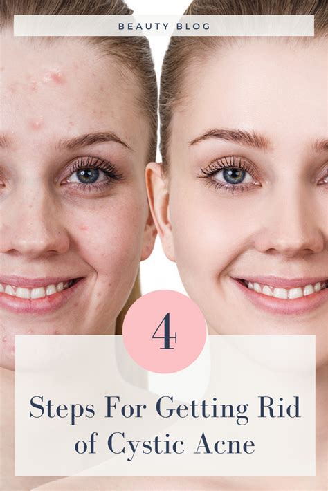 Cystic Acne 4 Steps To Clear Skin Biokosmetik Professional Skin Care