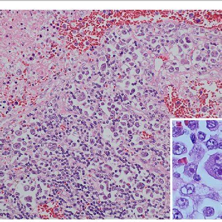 High Magnification Histological Findings From The Biopsy Specimen