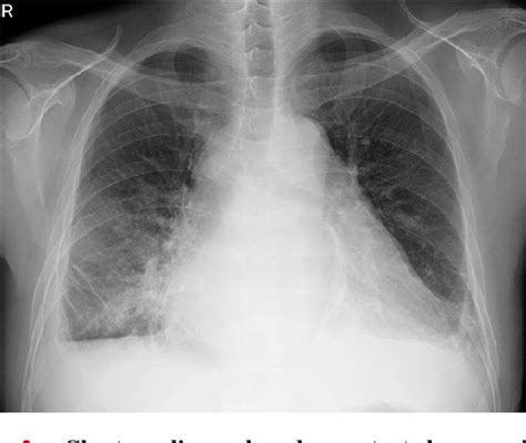 Figure From Endobronchial Ultrasound Guided Transbronchial Needle