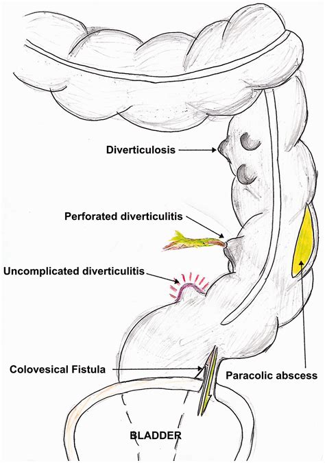 Diverticulitis Abscess