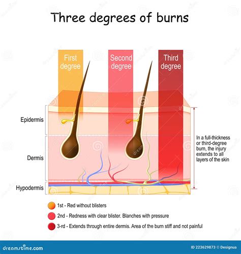 Skin Burn Injury Treatment First Aid For Burn Wound Vector