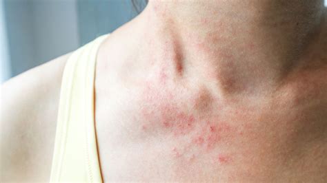 Micose Saiba O Que é E Como Tratar Dermatologia