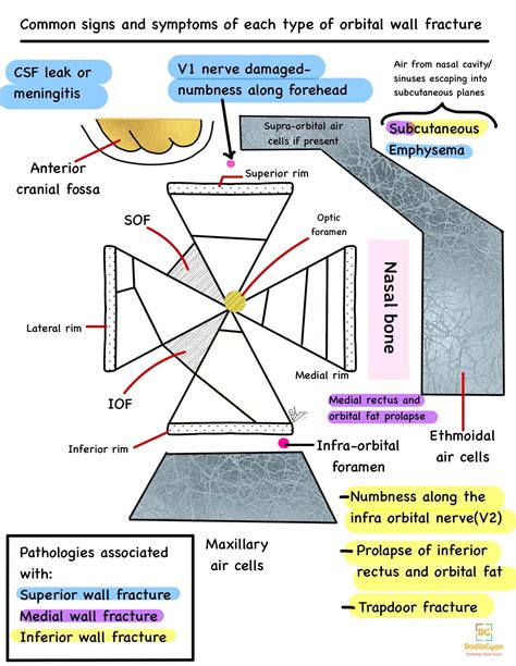 Blow out fracture of the Orbit | Radiology Case | - RadioGyan