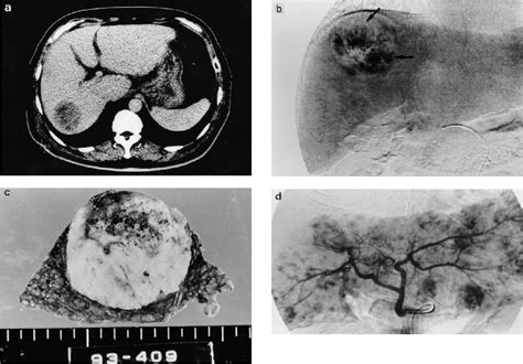 Figure 1 From Hepatocellular Carcinoma And Liver Transplantation Clinicopathologic Analysis Of