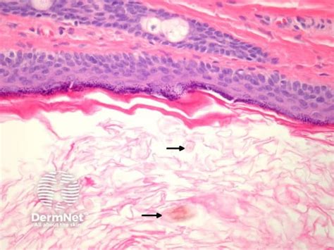 Dermoid Cyst Pathology