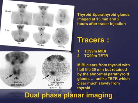 Radionuclide Imaging Of Parathyroid Glands Ppt