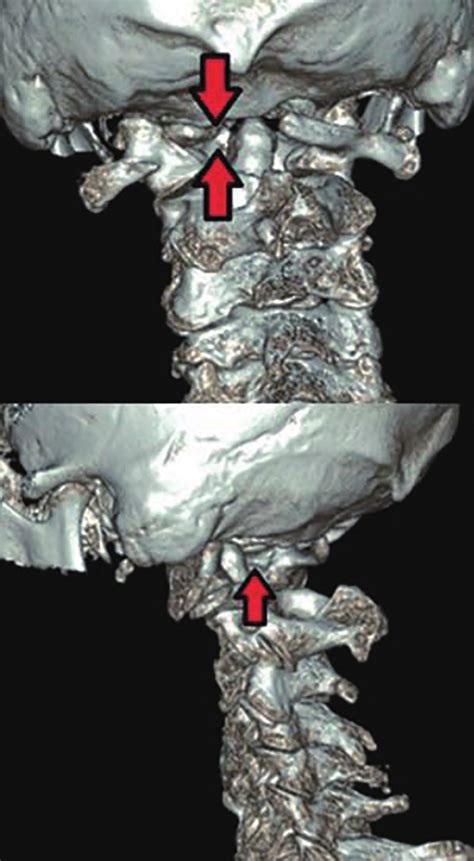 Ct Angiogram Showing Normal Course Of Left Vertebral Artery Download