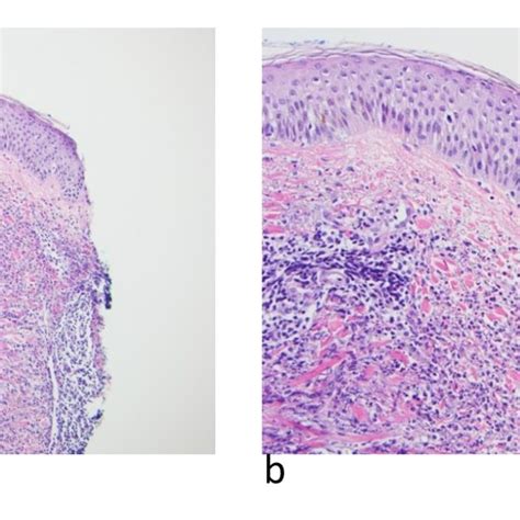 Punch Biopsy Of Lesional Skin A 100x And B 200x Demonstrating A