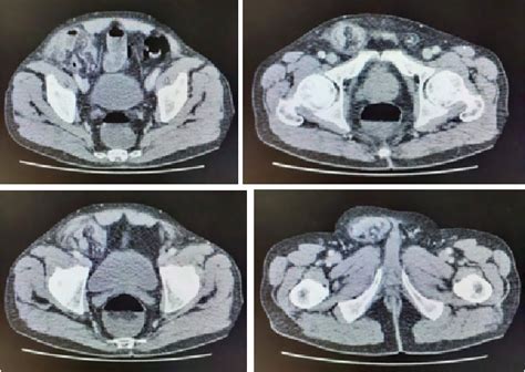 Figure 3 from INCARCERATED LITTRÉ S HERNIA A CASE REPORT Semantic