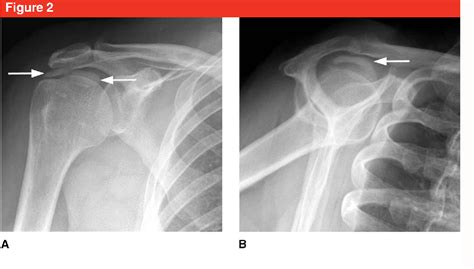 Rotator Cuff Calcific Tendinitis