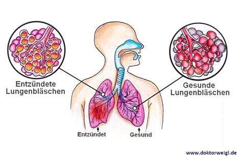 DoktorWeigl erklärt Lungenentzündung Pneumonie Mit Husten