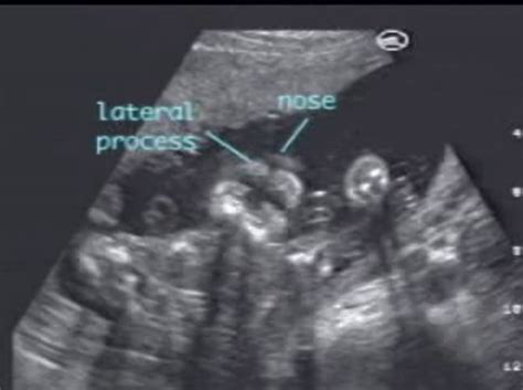 Cleft Lip Palate Unilateral Ultrasoundpaedia