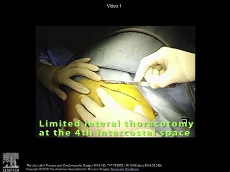 Systemic and regional pulmonary function after segmentectomy - ppt download