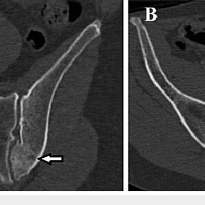 MRI imaging demonstrates the lesion in the left iliac bone (white ...