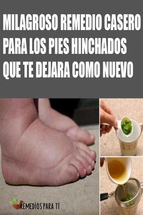 PODEROSOS Remedios Caseros Para Los Pies Hinchados TE VAN SORPRENDER