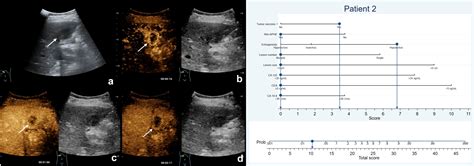 Frontiers A Nomogram Based On Ultrasonographic Features And Clinical