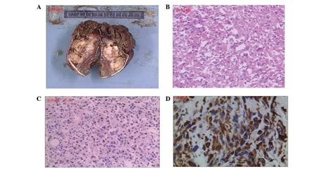 Misdiagnosis Of Primary Pleomorphic Rhabdomyosarcoma Of The Right Thigh