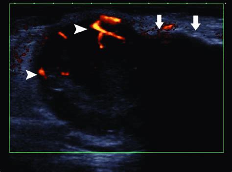 Groin Lymph Node Cancer In Men