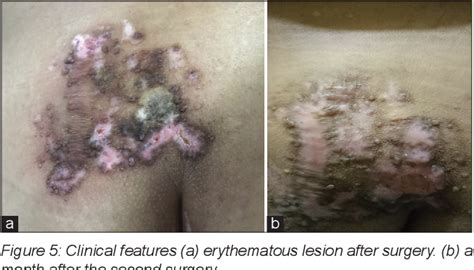 Nevus Lipomatosus Cutaneous Superficialis With A Histopathological