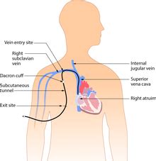 Central venous catheter - Wikipedia