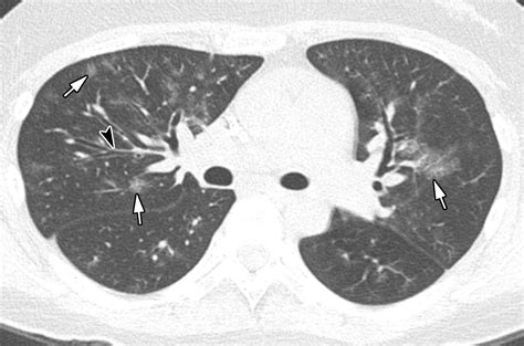 Radiographic And CT Features Of Viral Pneumonia RadioGraphics