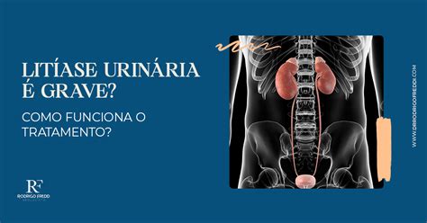 Litíase urinária é grave Como funciona o tratamento Dr Rodrigo Freddi