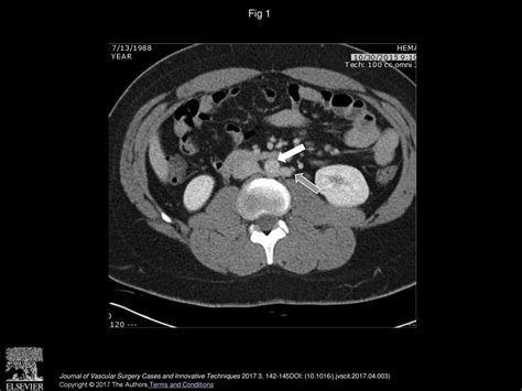 A Novel Hybrid Left Renal Vein Transposition And Endovascular Stenting