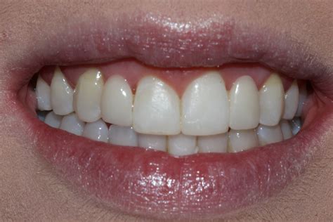 Excel Dental | Straight white healthy teeth