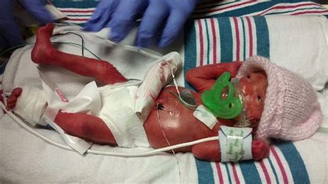 Premature Birth On The Rise