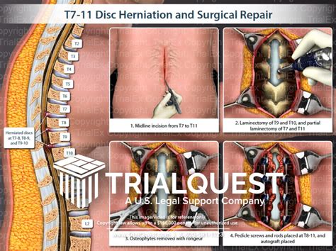 T7 11 Disc Herniation And Surgical Repair TrialQuest Inc