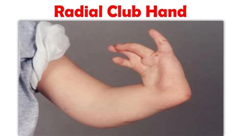 Radial Club Hand By Kids Orthopedic Issuu