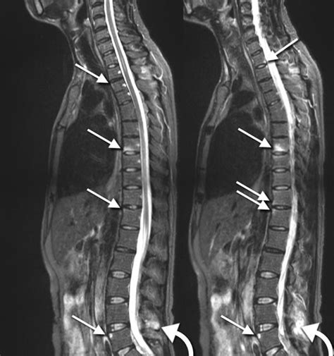 What are the symptoms of a bulging disc in the thoracic spine? - Health ...