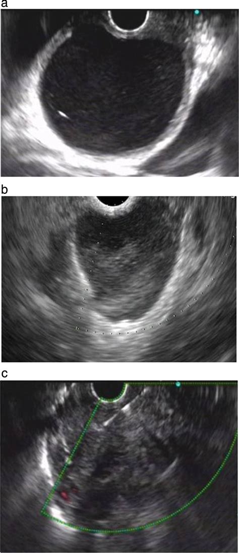 A Endoscopic Ultrasound Eus Images Mhz Of A A Cm