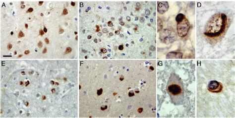 Ews Pathology In Ftld Fus Ews Immunohistochemistry Performed On